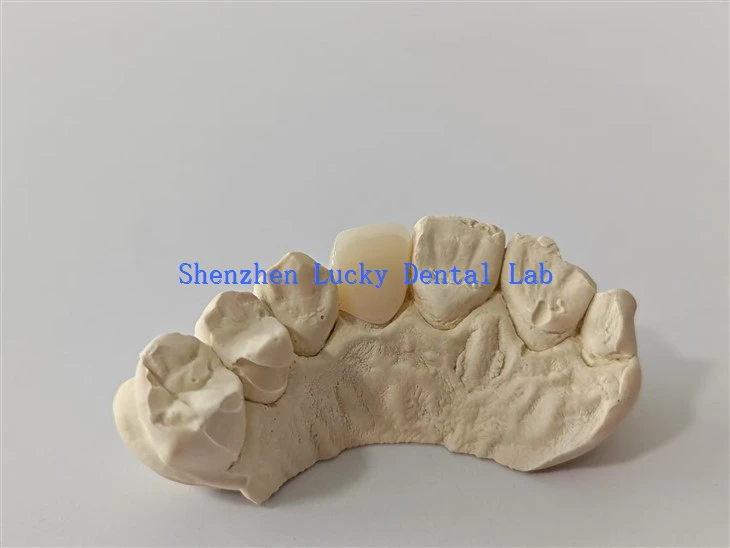 Corona di zirconia dentale