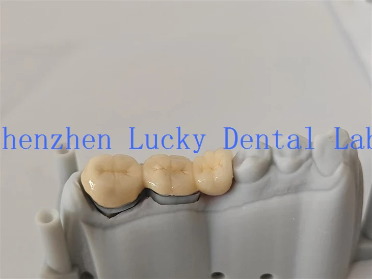 Comfortable Zirconia Crown And Die Dental Lab
