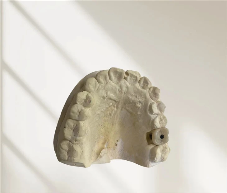 Screw Retained Implant Bridge