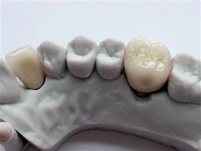 PFM Cocr Dental Crown No Metal Margin Dental Lab