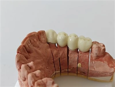 PFM Cocr Dental Bridge No Metal Margin Dental Lab